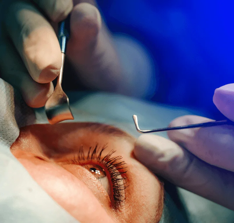 Corneal surgery at Vasan eye care hospital in Colombo
