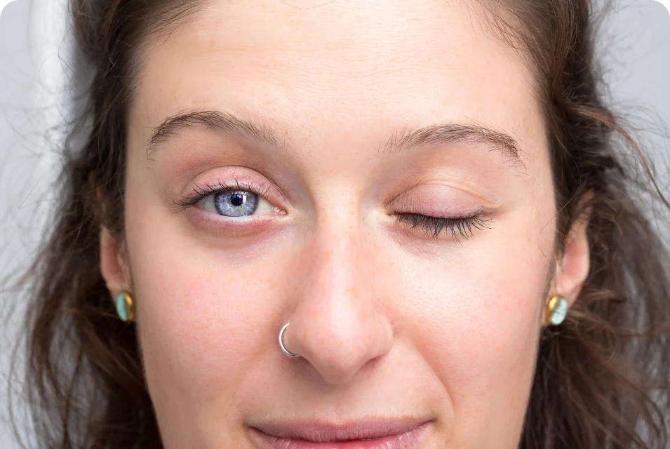 ocular plasty