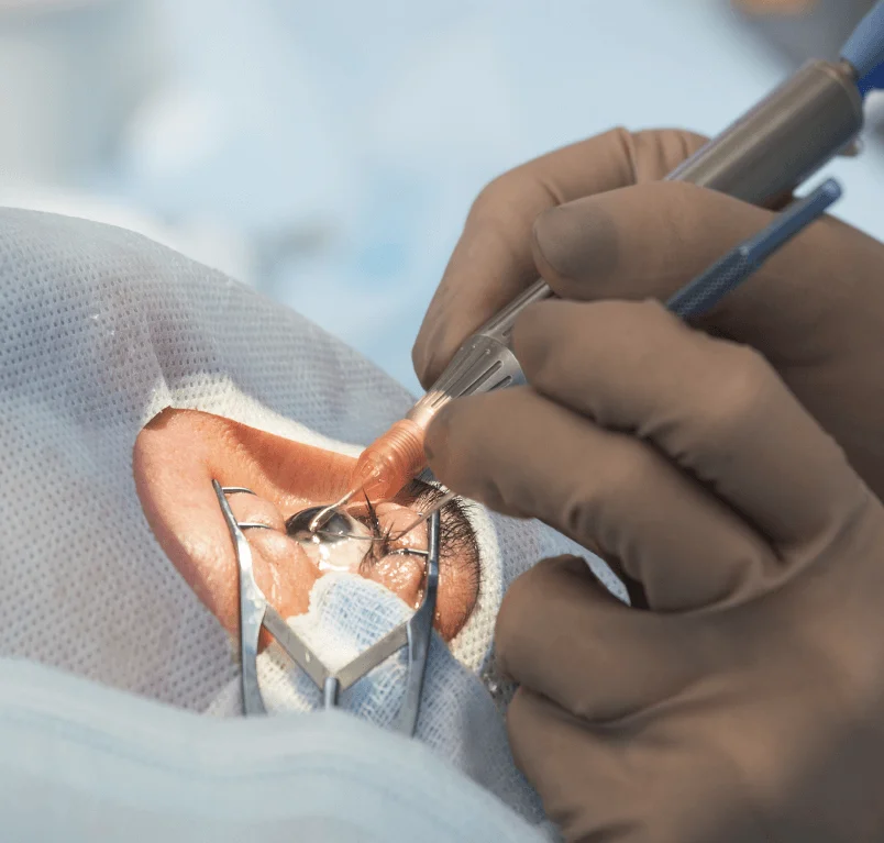 retinal surgery