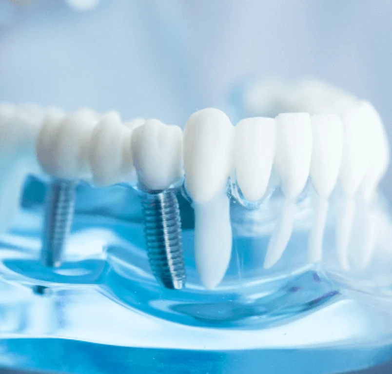 Dental implant services at Vasan Healthcare Hospital